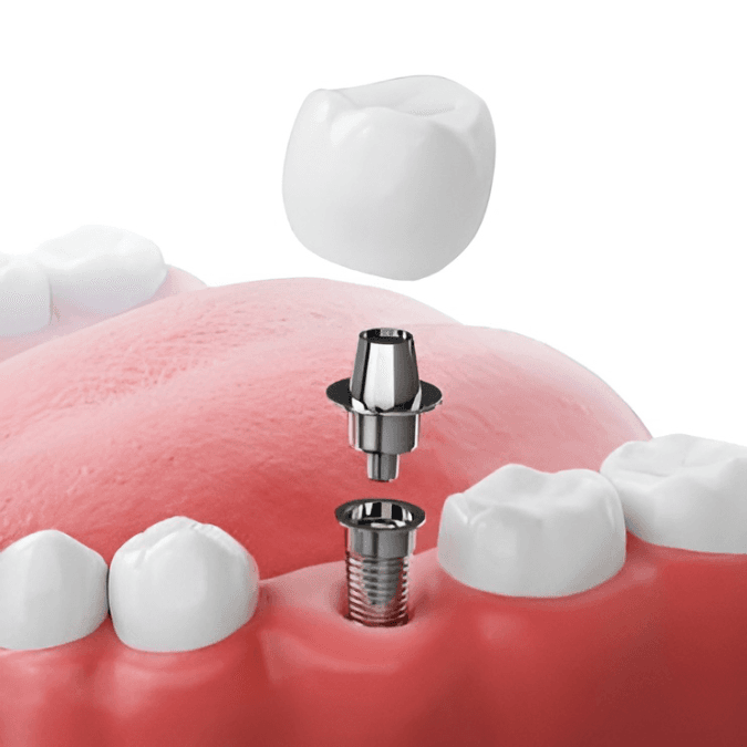 Imagem Ilustração Implantes