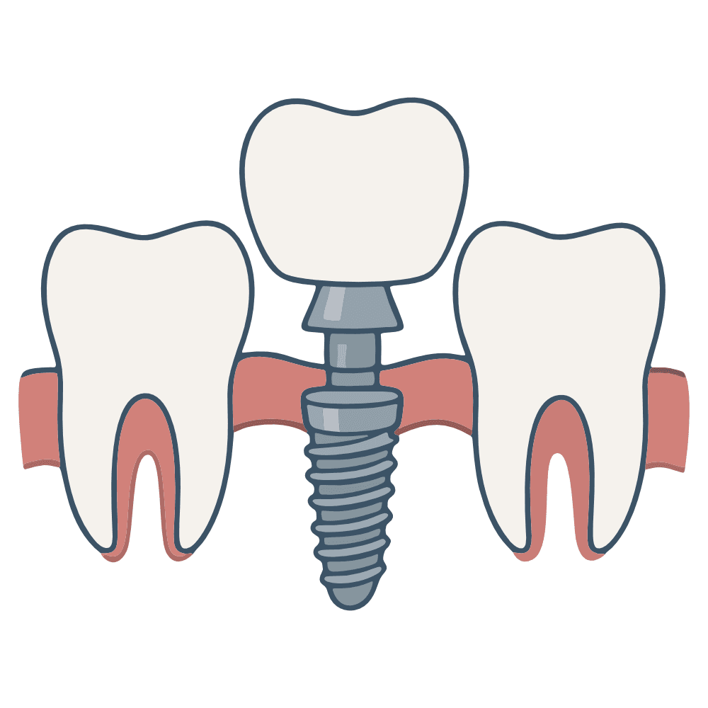 Imagem Ilustração Implantes