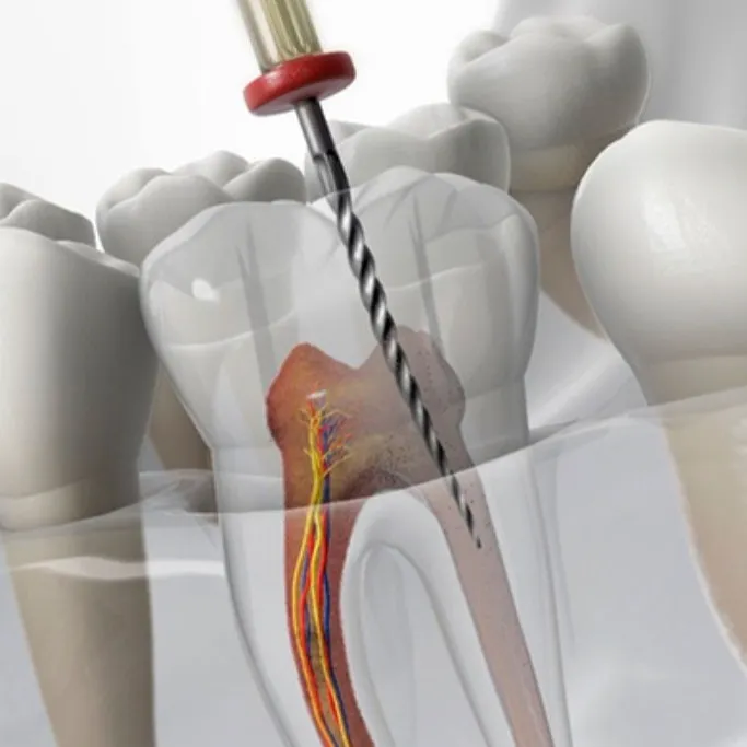 Imagem Ilustração Tratamento de Canal